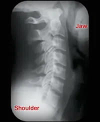 X-ray of textbook “normal” side view of the neck. X-ray of normal side view of neck