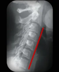 The first thing you notice is a loss of the normal cervical curve. Phase one spinal decay