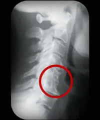 The affected bones have lost their individuality and ability to move. Phase three spinal decay